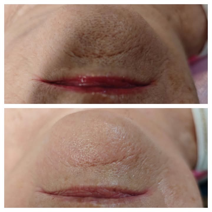 Efekt zabiegu Bloomea 1