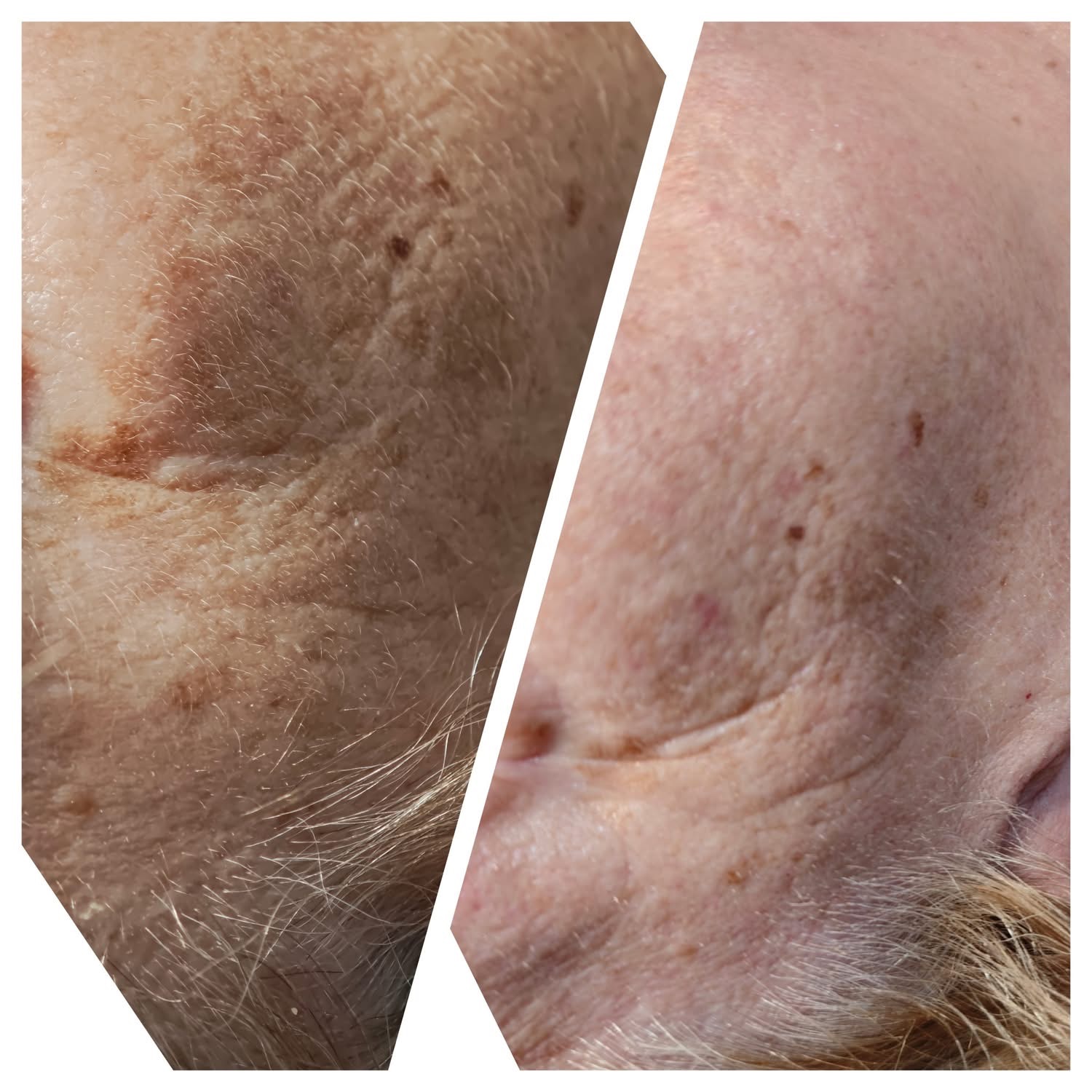 Efekt zabiegu Bloomea 3