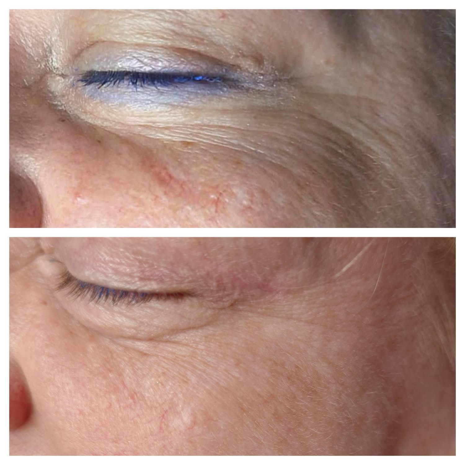 Efekt zabiegu laserowego 2