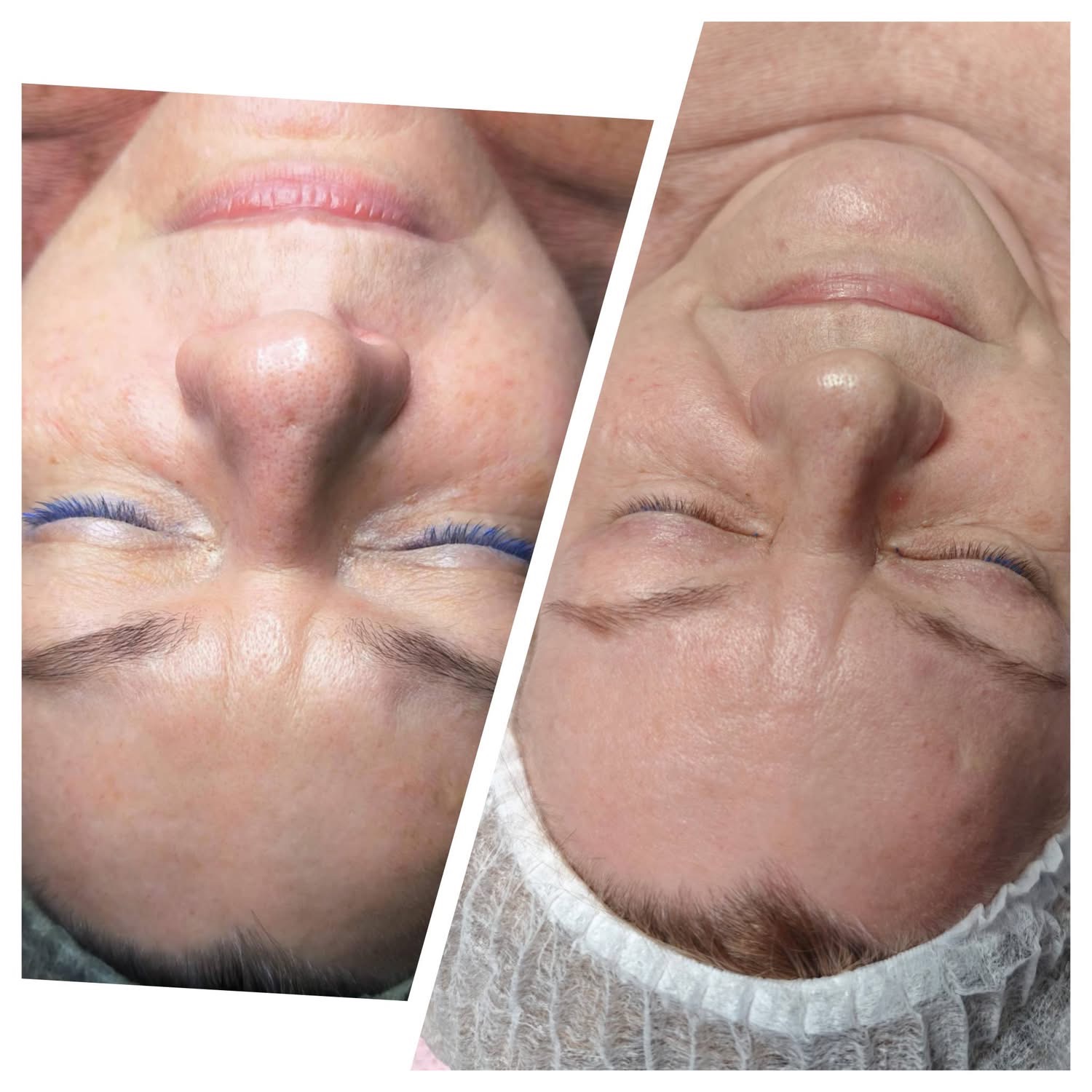 Efekt zabiegu laserowego 3